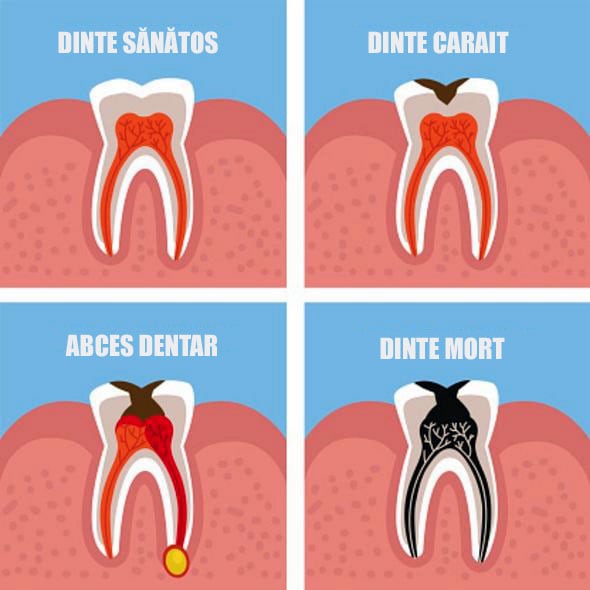 Abces dentar grafic