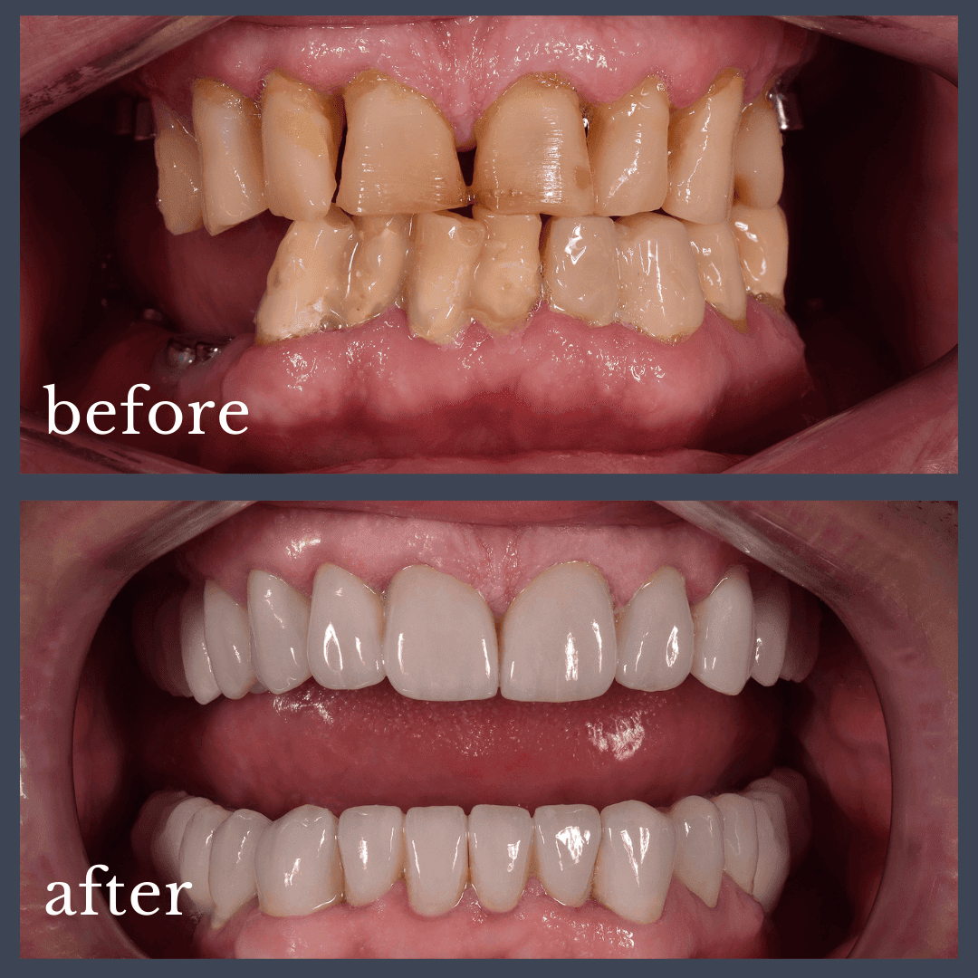Caz 1 implant dentar
