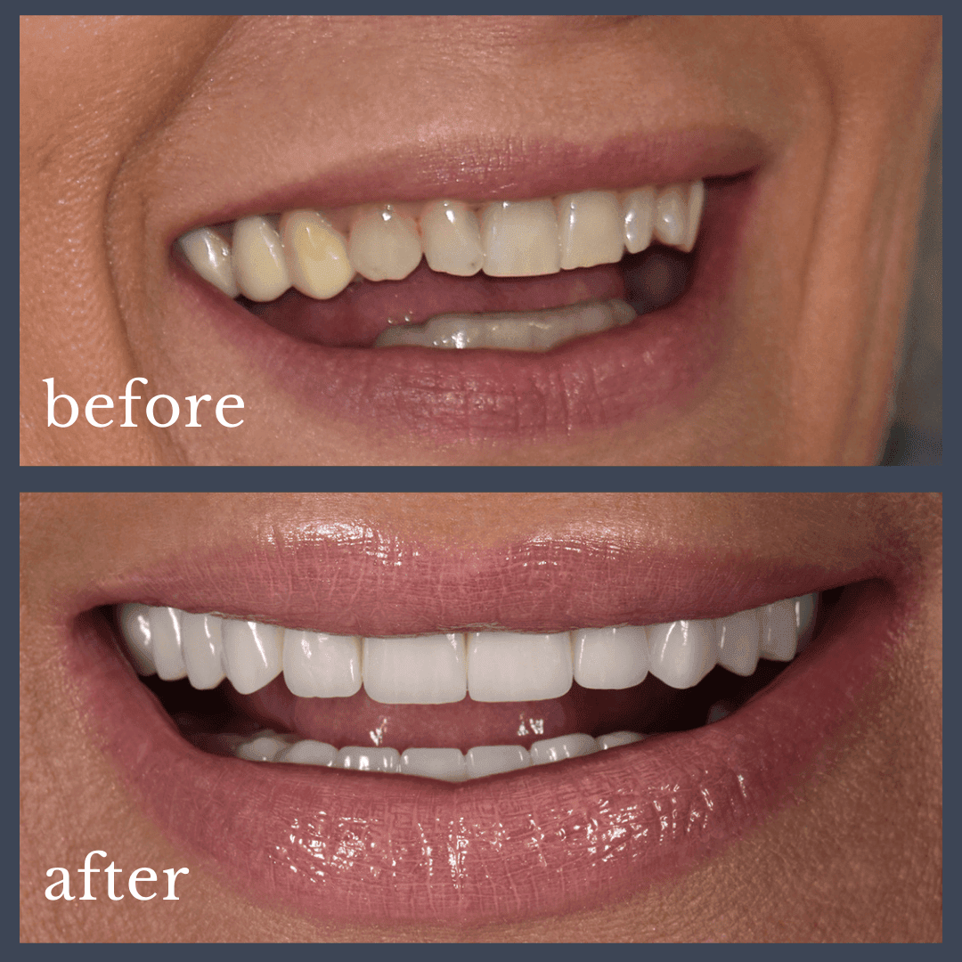 Caz 2 implant dentar