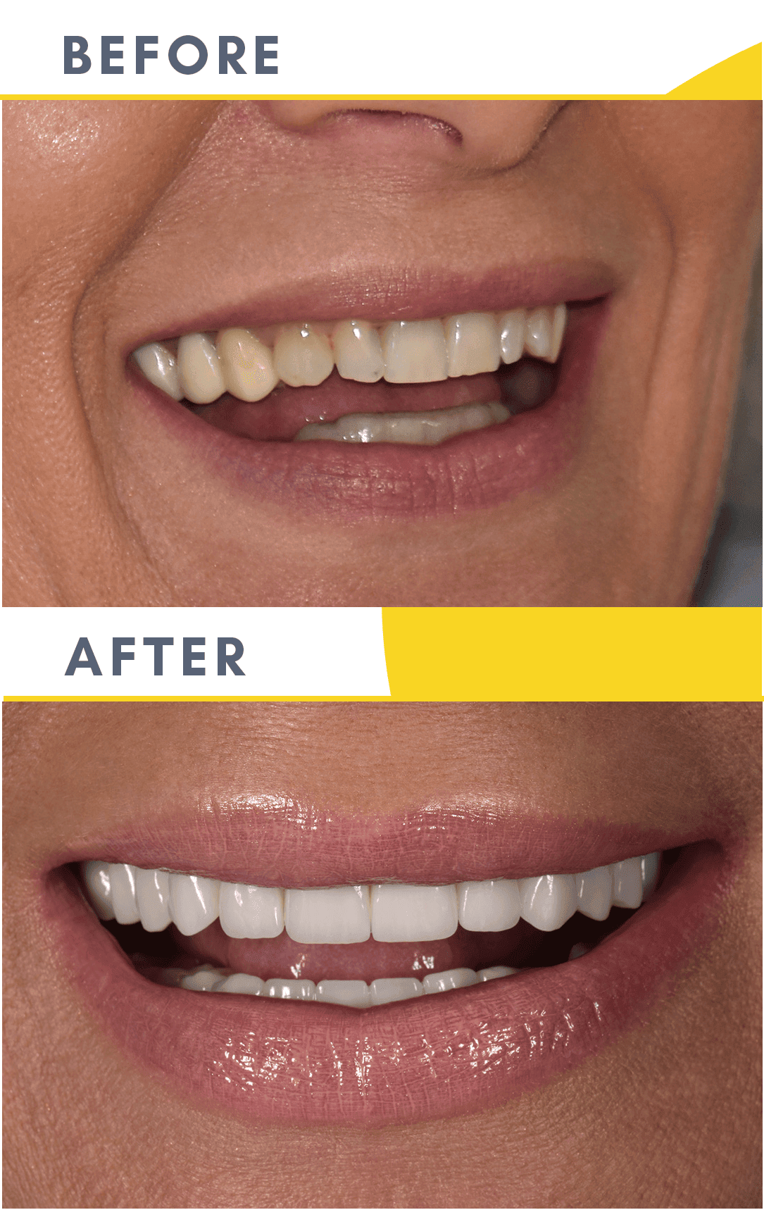 Cazuri Clinica Dentaline Coroane Dentare