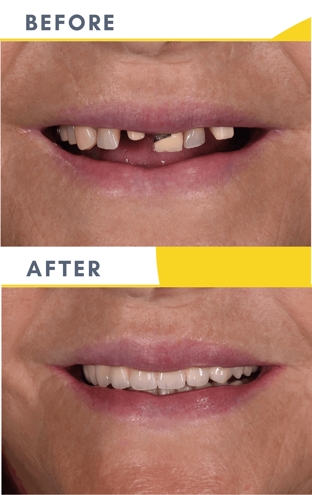 Cazuri Clinica Dentaline Implant Dentar