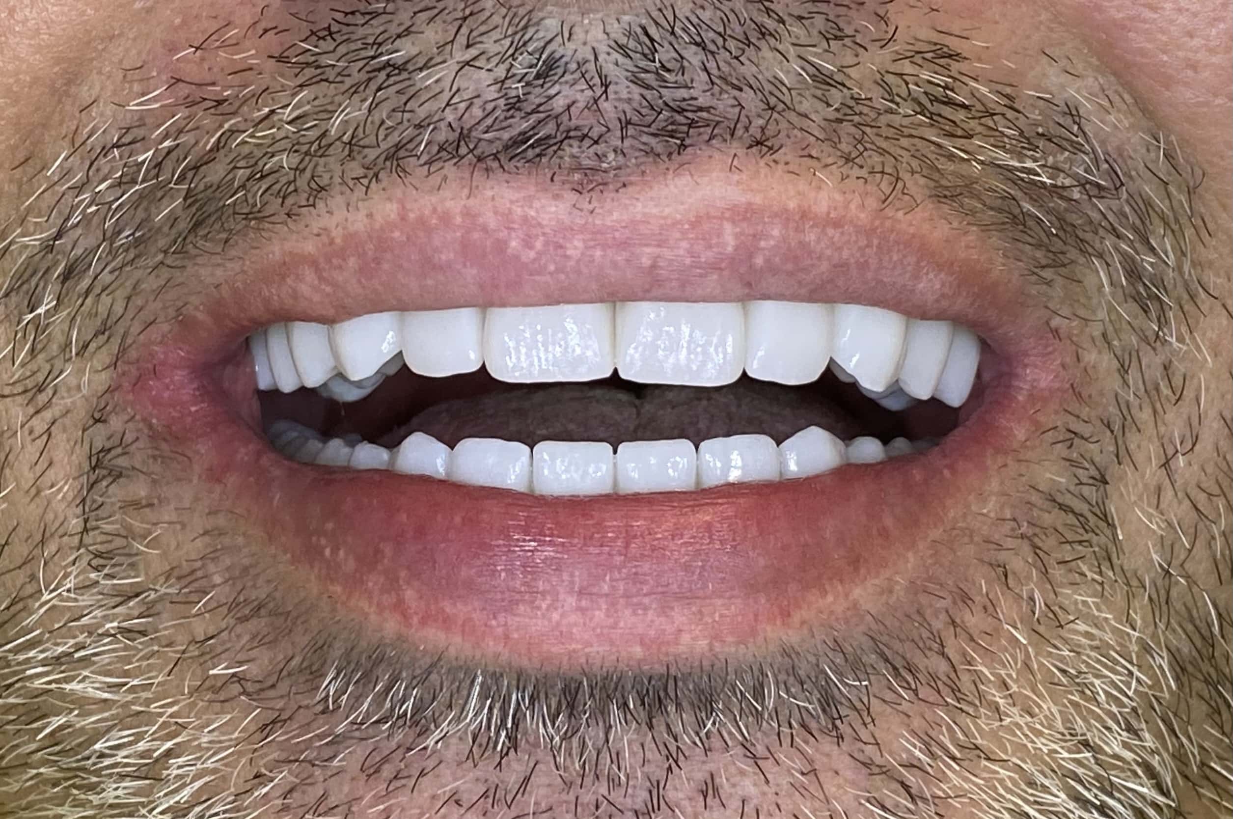 rezultat tratament implanturi dentare